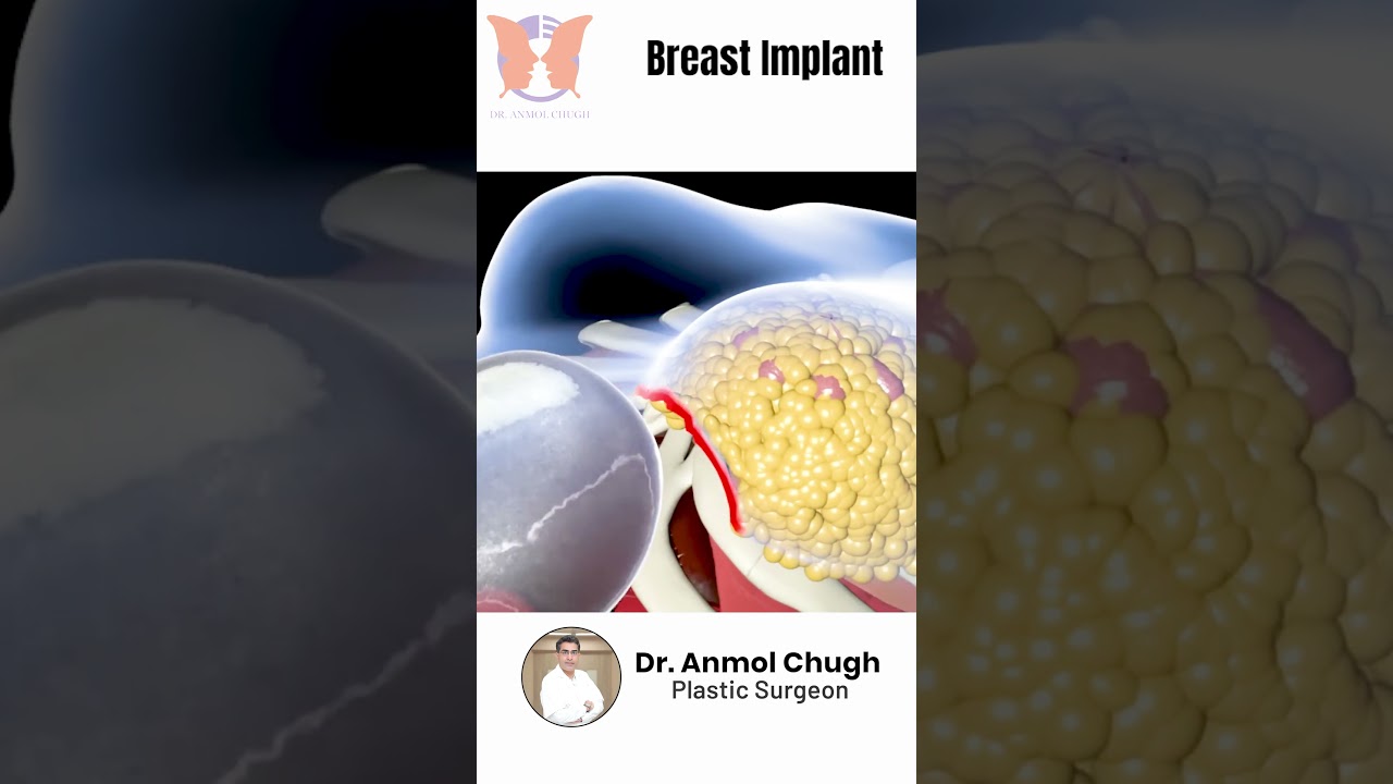 Breast Implant Surgery: How It&rsquo;s Done! | Dr. Anmol Chugh