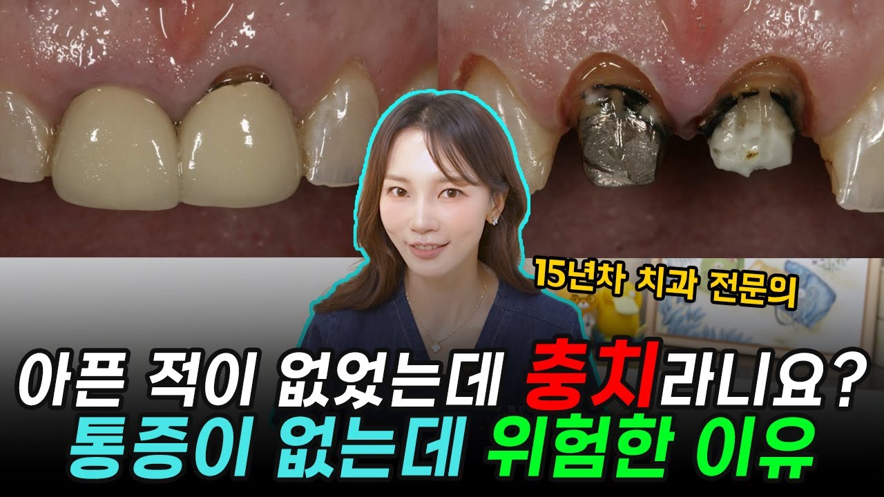 안 아파도 썩고 있는 '통증 없는 충치' / 주기적으로 치과를 가야하는 이유