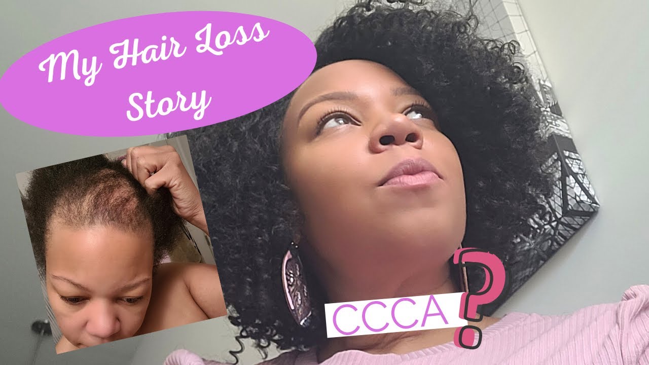 My HAIR LOSS Story// *CCCA ALOPECIA*