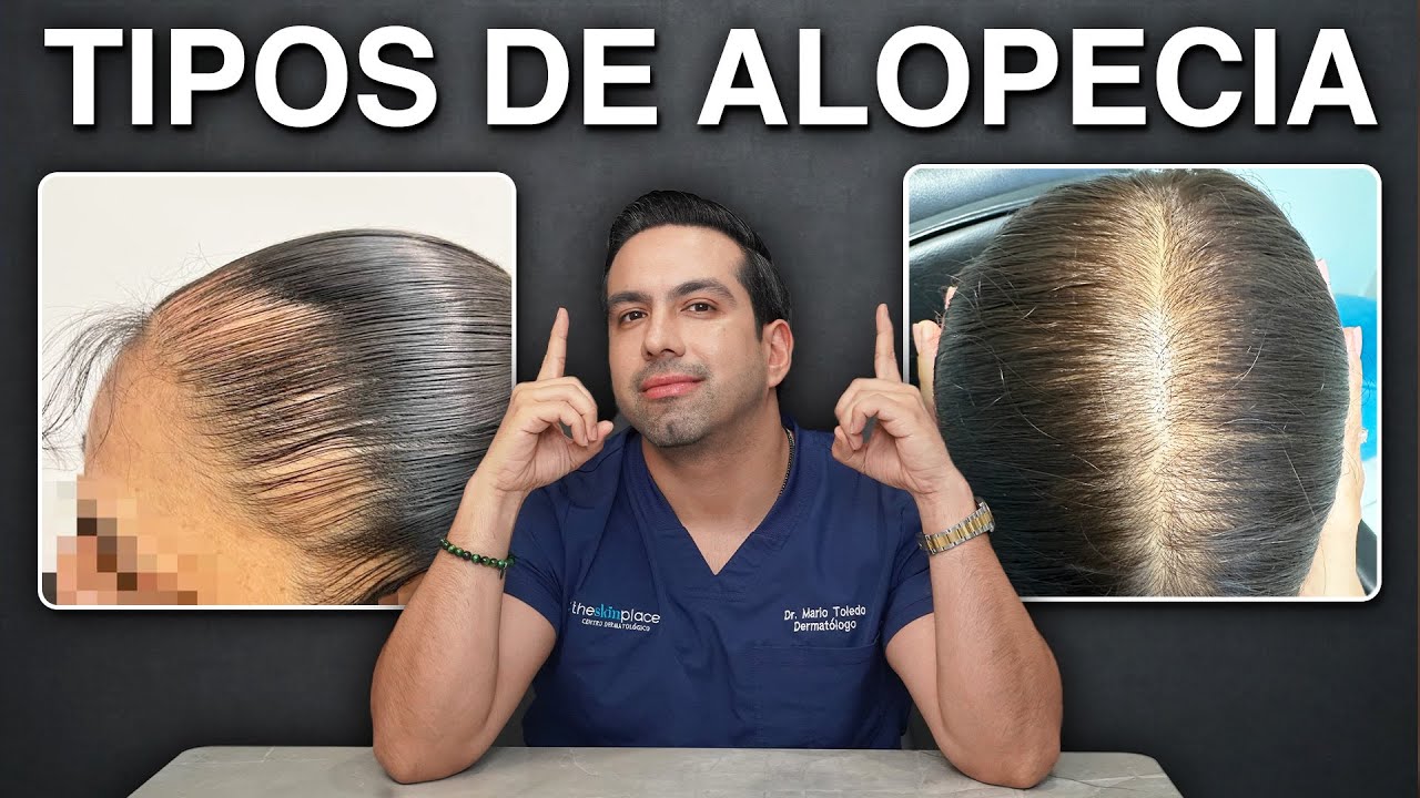 Tipos de alopecia, conoce las causas.