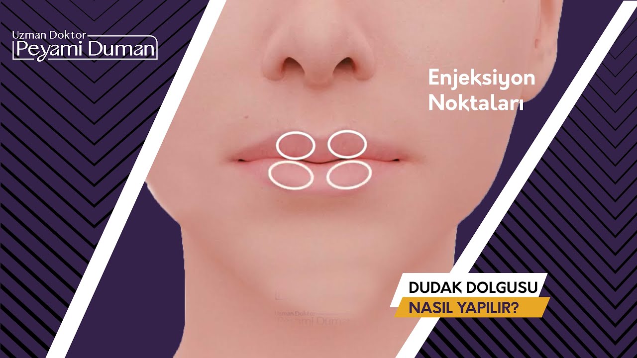 Dudak Dolgusu Nasıl Yapılır? Dudak Dolgusu Enjeksiyon Noktaları Nelerdir?