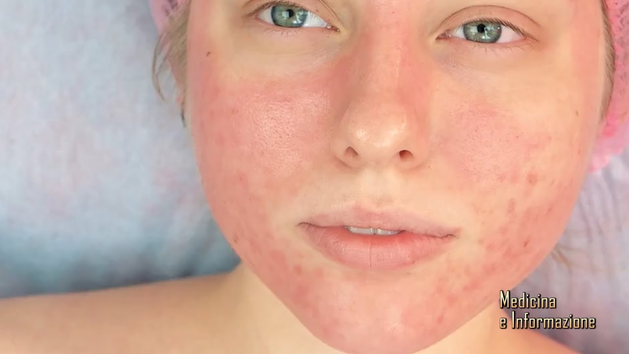 Lupus Eritematoso Sistemico: le nuove opzioni terapeutiche