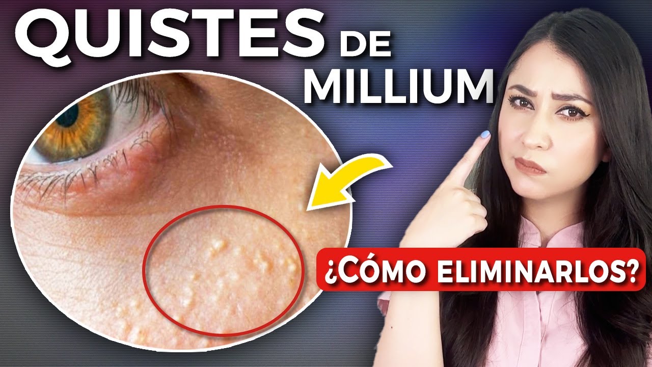 QUISTES DE MILLIUM l ¿Qué son y CÓMO ELIMINARLOS?👩🏻‍⚕️ 