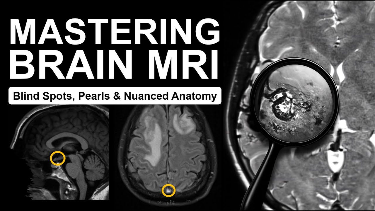 Mastering Brain MRI: Blind Spots, Pearls & Nuanced Anatomy