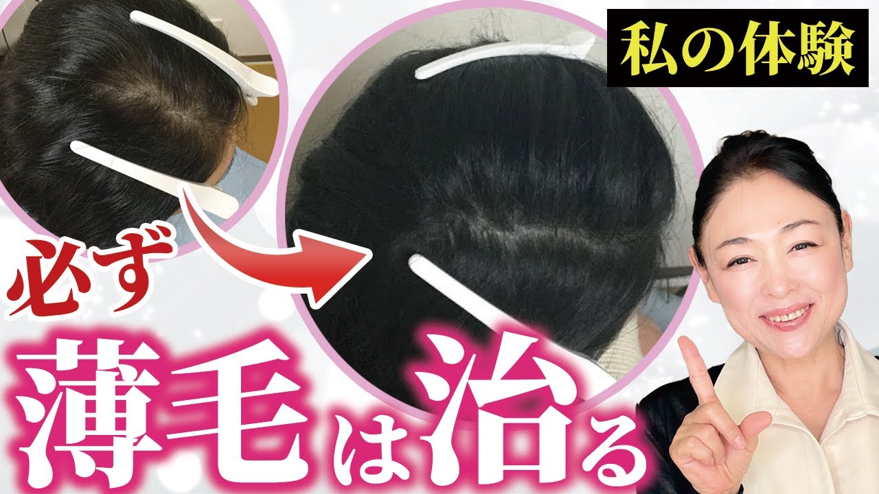 【完全解説】絶対に知っておくべき！女性の4つの薄毛・抜け毛予防策
