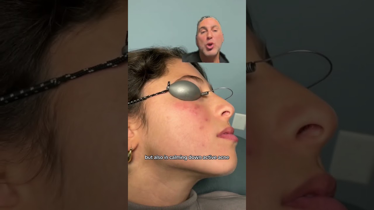 Laser Treatment of Red Marks Associated with Acne