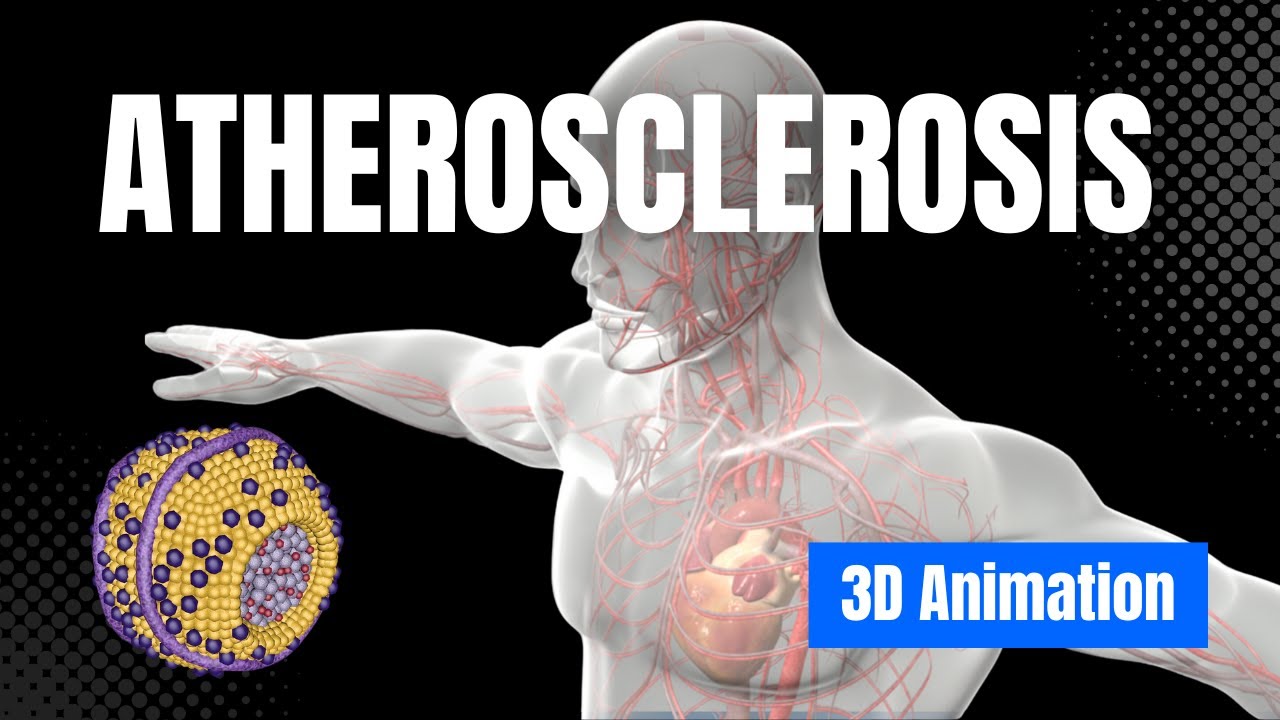 Узнайте больше об атеросклерозе - 3D-анимация