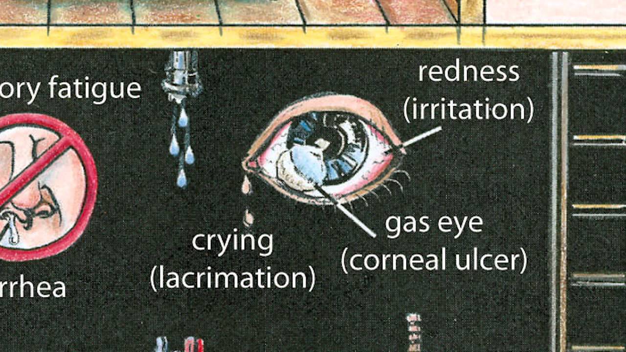 Hydrogen Sulfide Poisoning