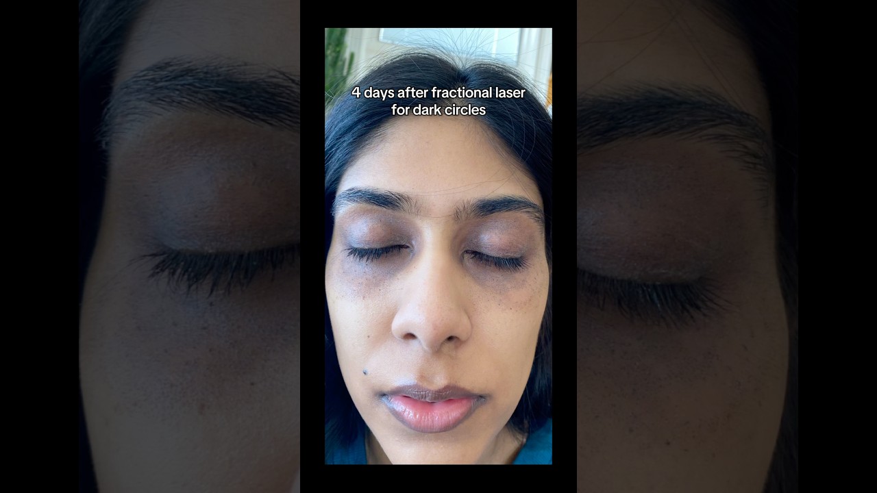 Laser for dark circles #darkcircles #darkcirclestreatment