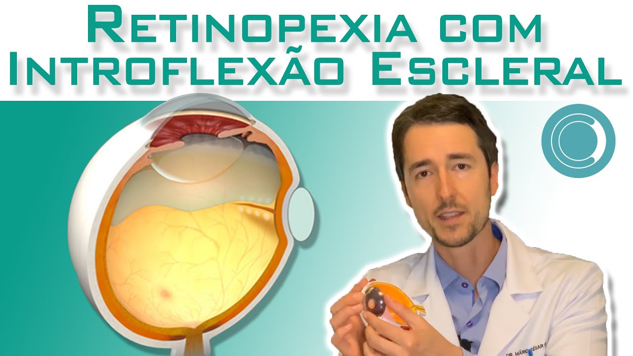 Cirurgia para descolamento de retina | Retinopexia com introflex&atilde;o escleral