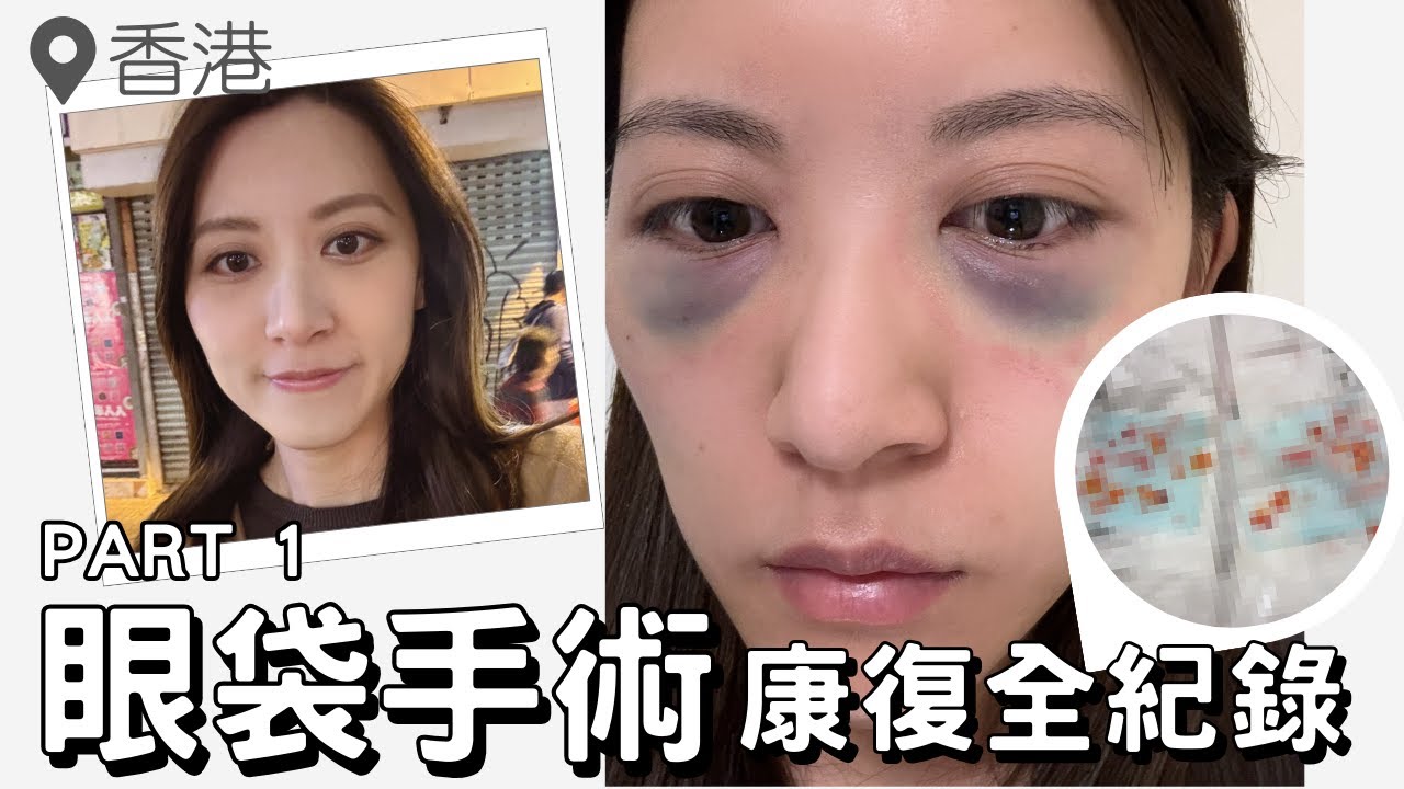 【眼袋手術Part 1】術後康復全紀錄 Day 1-4｜怎樣護理？可以洗頭嗎？