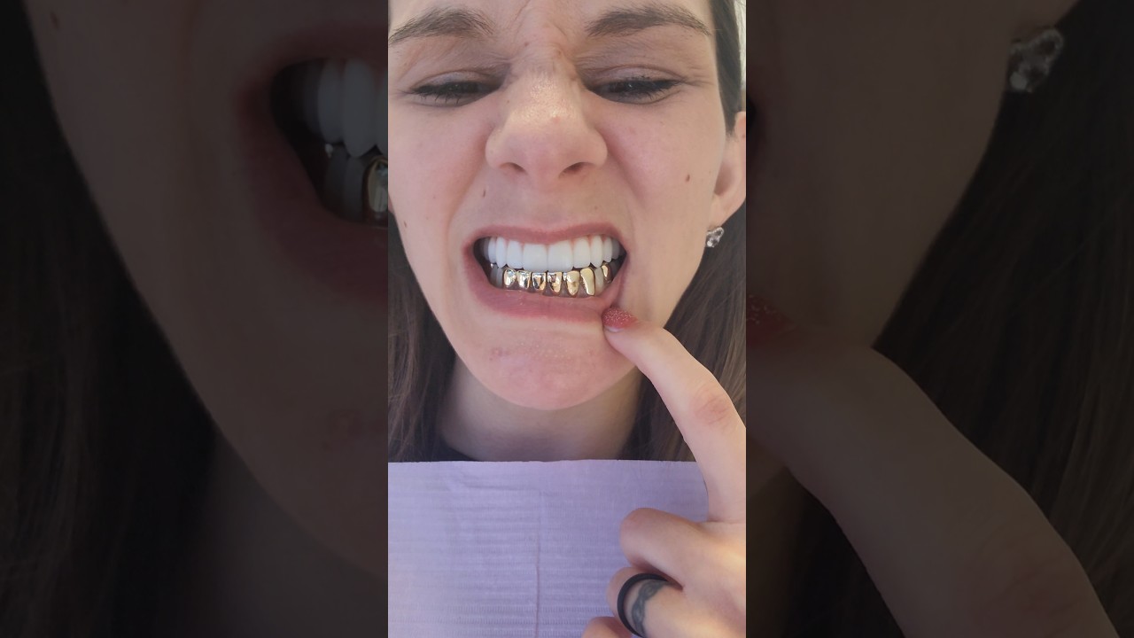 Custom GOLD #teeth & Dental implants  @jaximplantsanddentures 🌟 #gold #dentalimplants #dentist