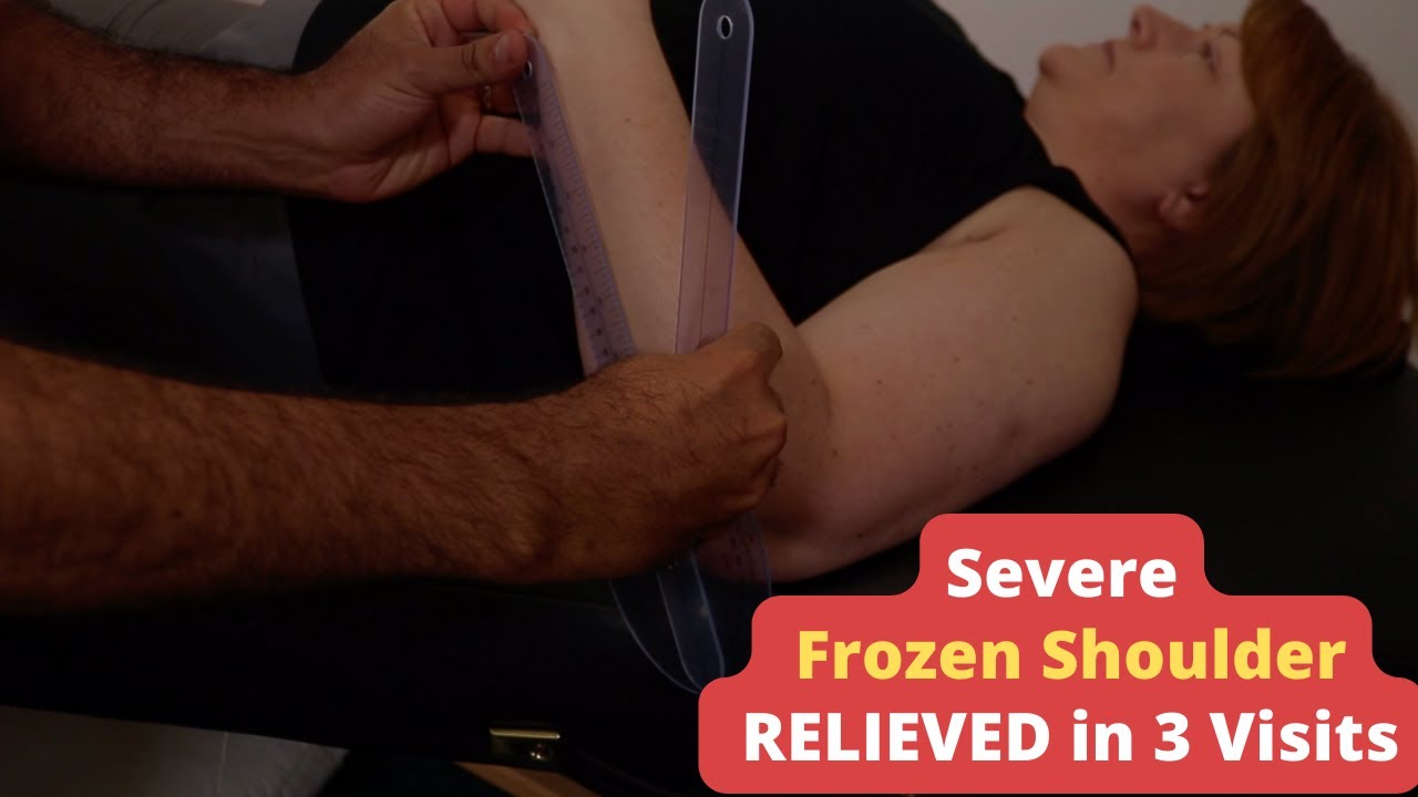 Severe Frozen Shoulder RELIEVED  in Just 3 Visits: See How!