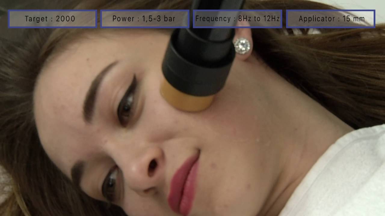 ESWT Skin Tightening / Facial Wrinkles by MODUS CELLULITE