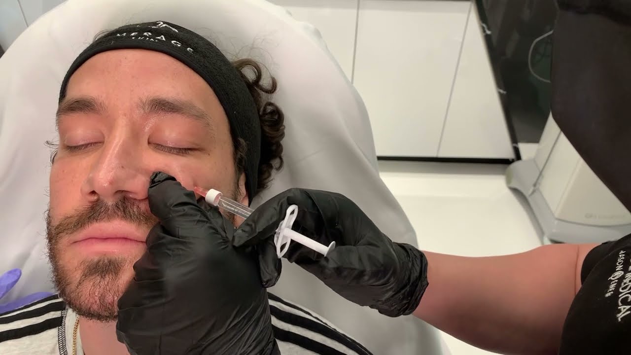 MALE FACIAL SCULPTING TO CHISEL HIS JAWLINE, CHIN AND CHEEKS +  BRIGHTEN UNDER EYES | Dr. Jason Emer