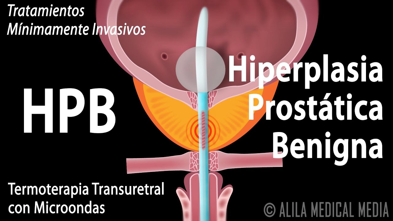 Hiperplasia Prost&aacute;tica Benigna, HPB,  y Tratamientos. Alila Medical Media Espa&ntilde;ol.