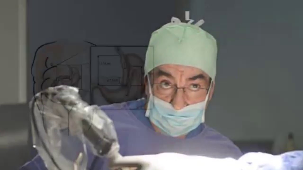 BYPASS GASTRICO DE UNA ANASTOMOSIS BAGUA DR  MIGUEL FLORES