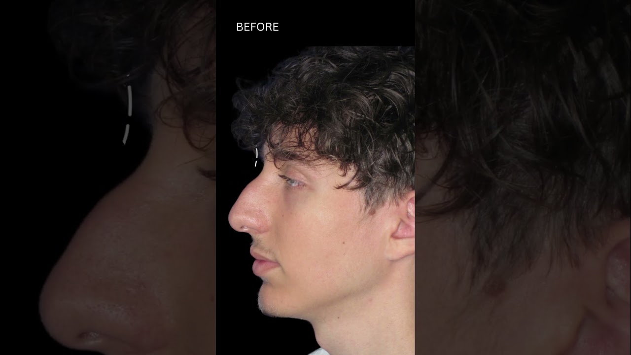 Nose Job Compilation Photos: Before & After #nosejobs