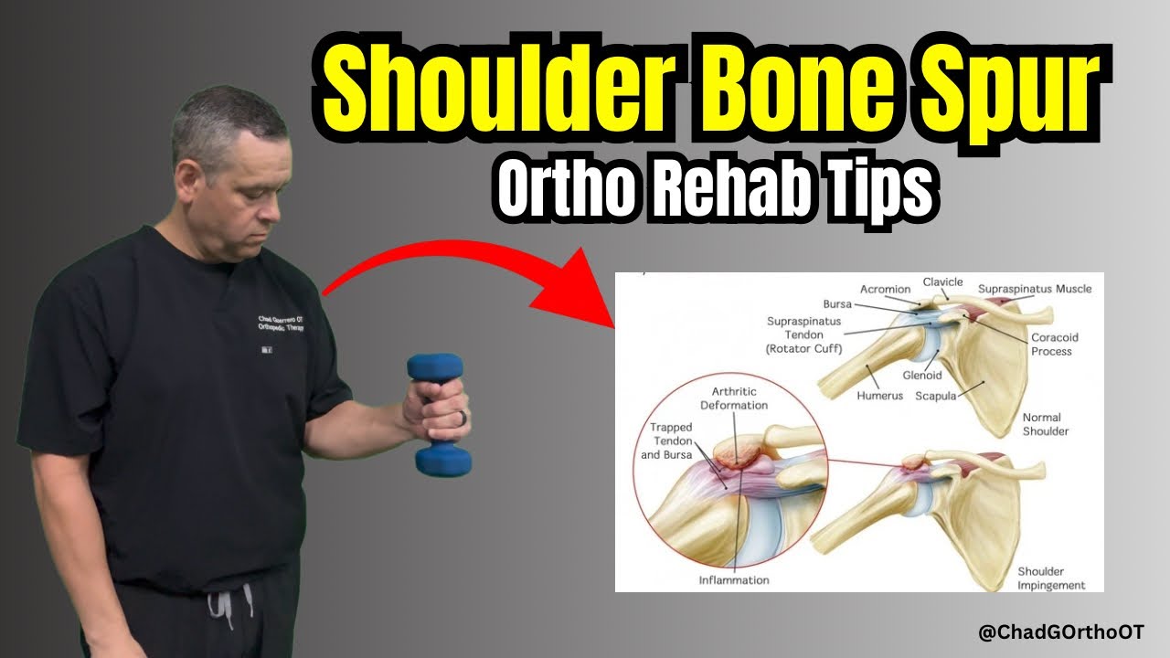 Костный нарост на плече? Попробуйте эту реабилитационную программу для облегчения боли у ваших па...