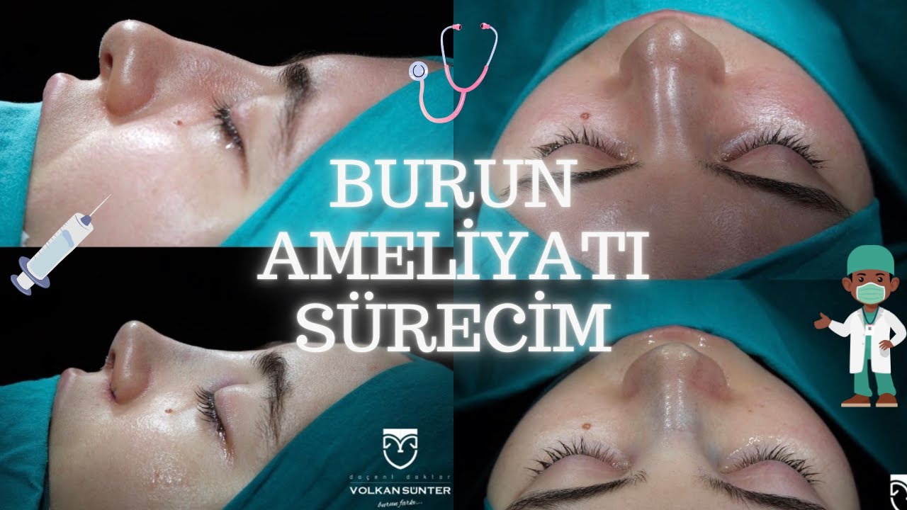 BURUN AMELİYATI ÖNCESİ / SÜRECİ / SONRASI 🩺 TÜM SÜREÇ ⏱️