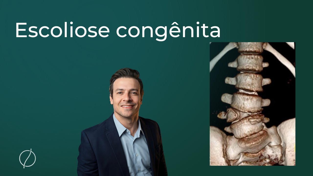 Escoliose congênita