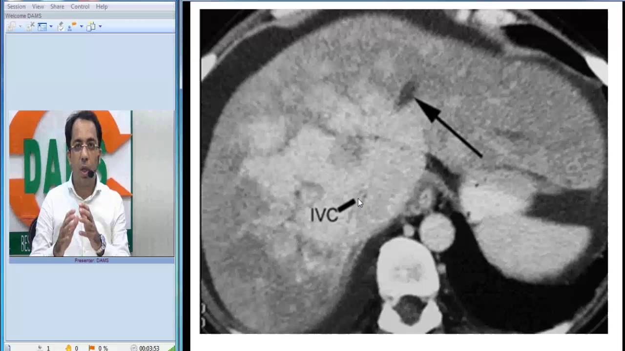 Radiology Spotters 28 - Budd Chiari Syndrome: CT by Dr. Sumer Sethi