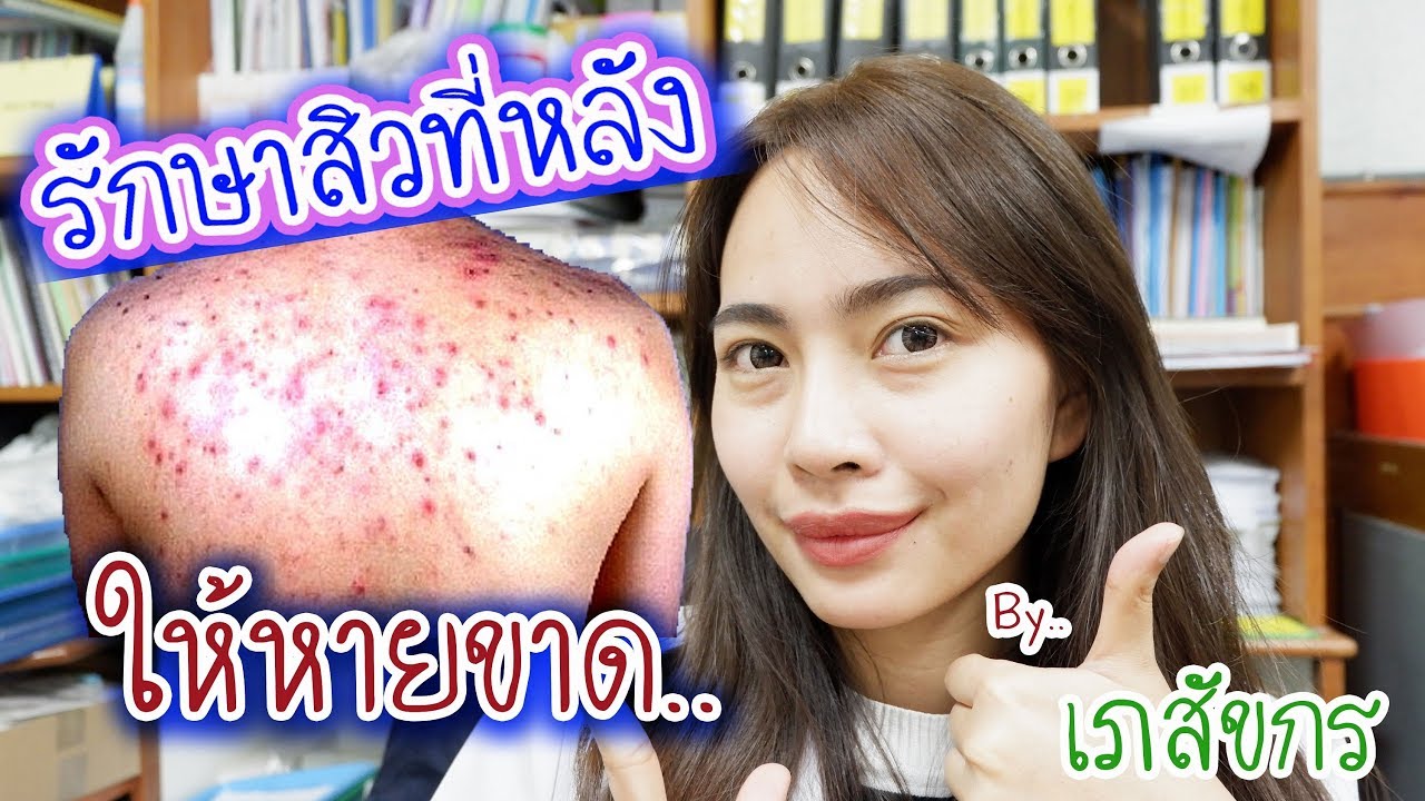 #33  รักษา สิวที่หลัง โดยเภสัชกร 🌏 เภสัชท่องโลก