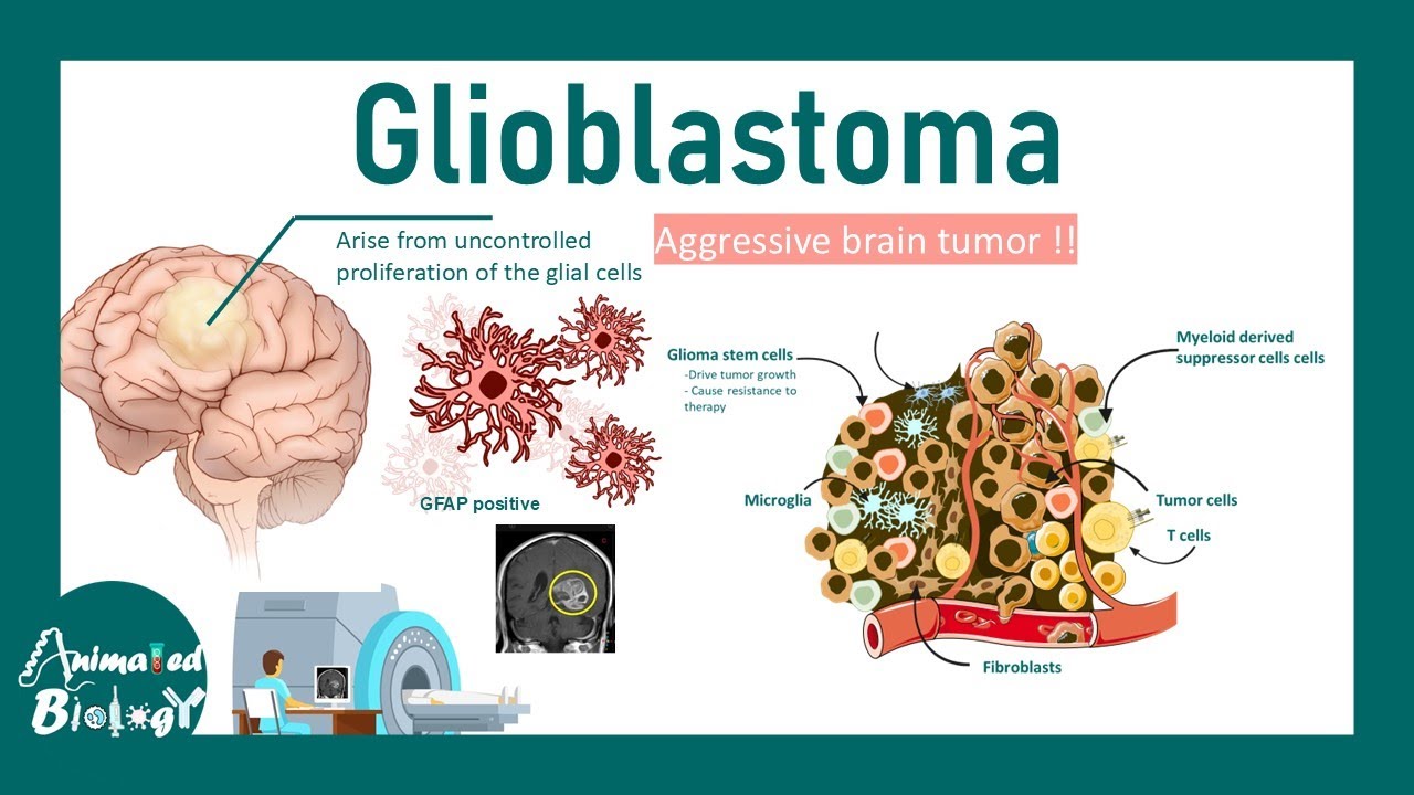 Glioblastoma | Cause of Glioblastoma | Molecular subtypes of glioblastoma | Treatment