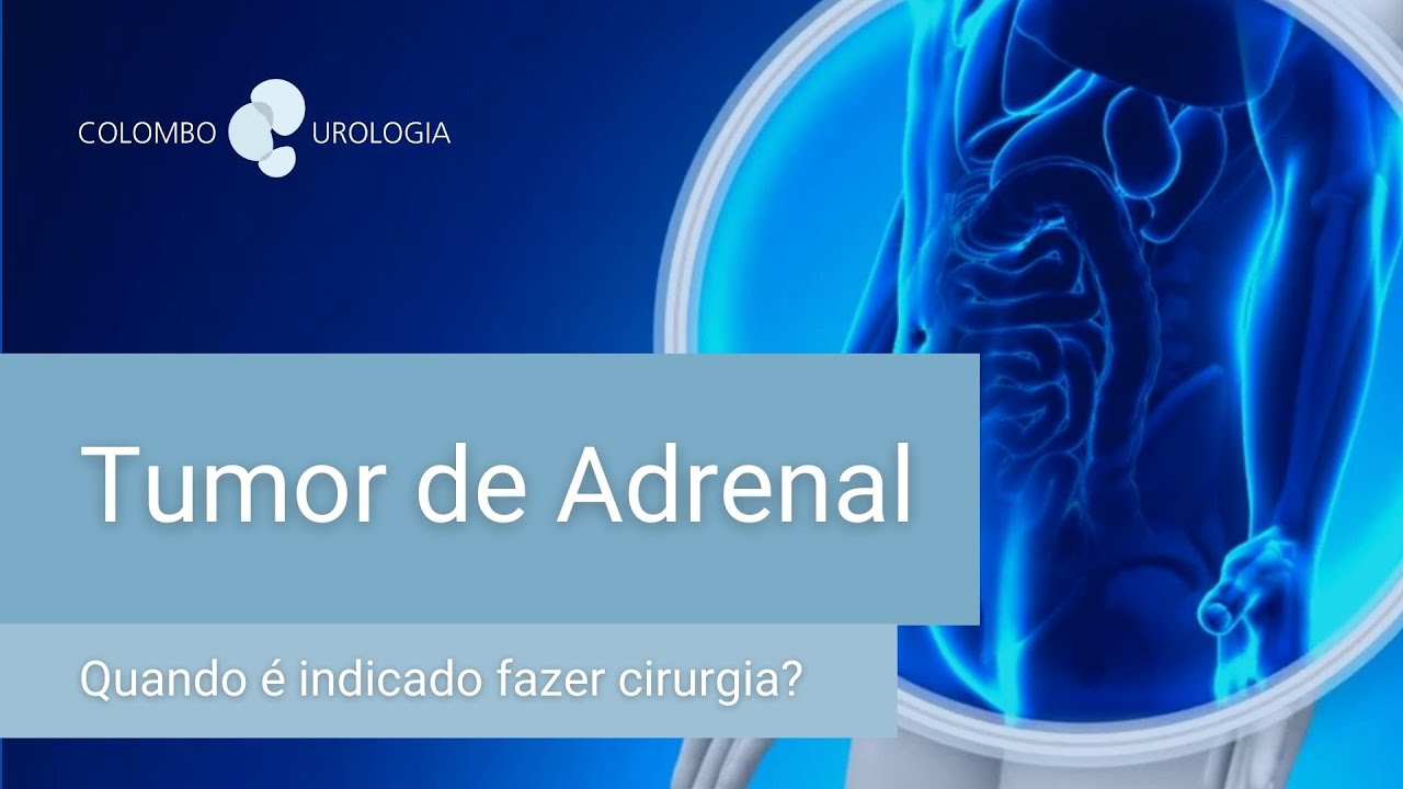Tumor de Adrenal: Quando é indicado fazer cirurgia? - Dr. José Roberto Colombo Jr