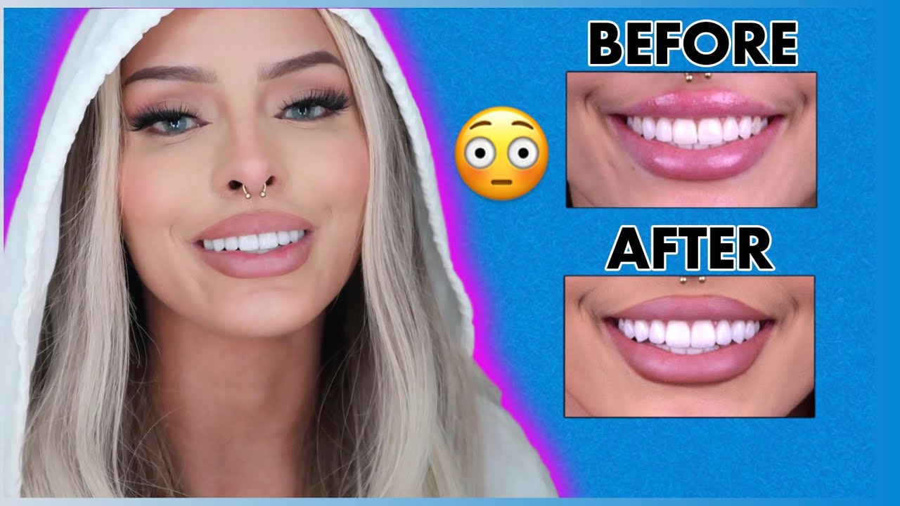 I RE DID MY SMILE DESIGN !! * SECOND TIME *  THE AFTER IS CRAZY!