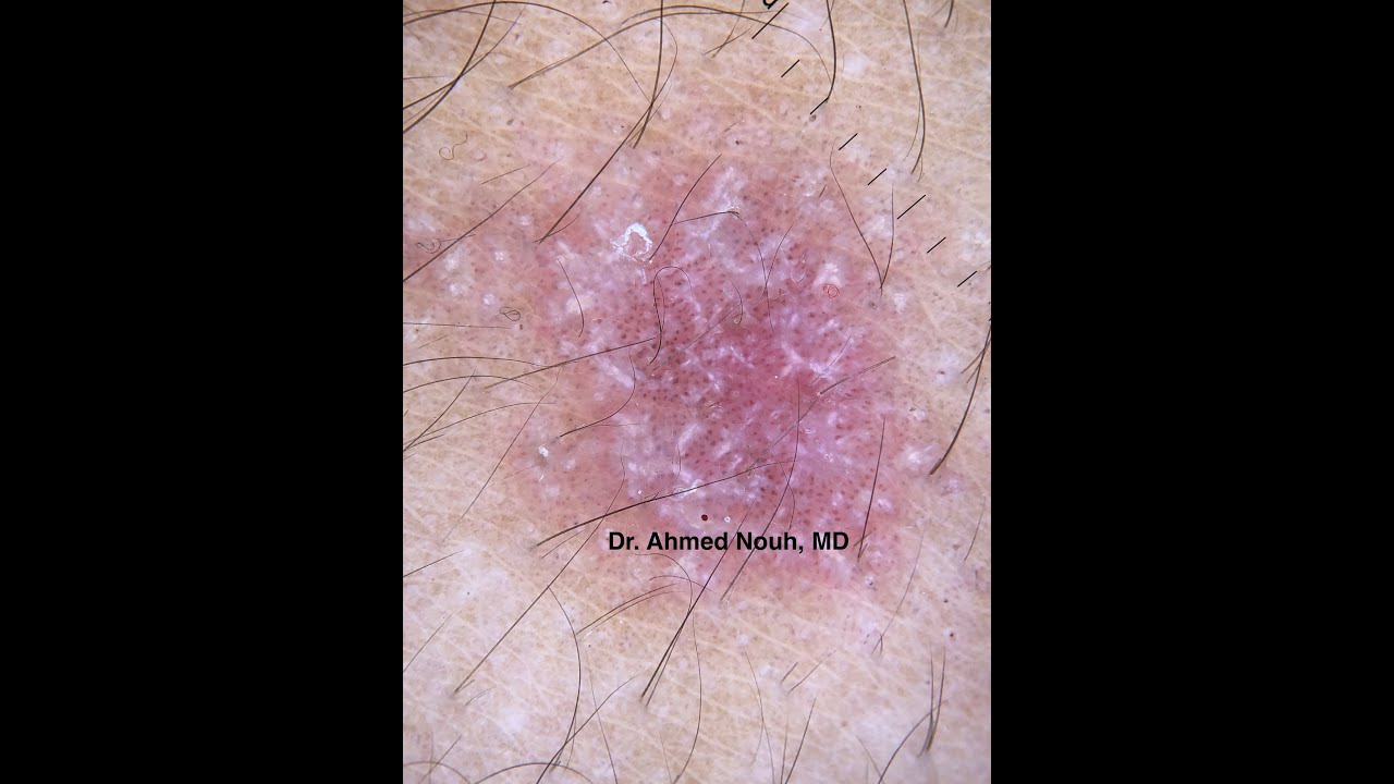 Clinical case discussion (Acute Generalized lichen)