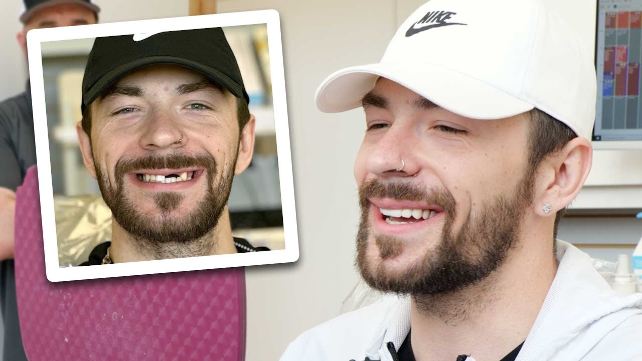 Smile Makeover with Full Mouth Crowns