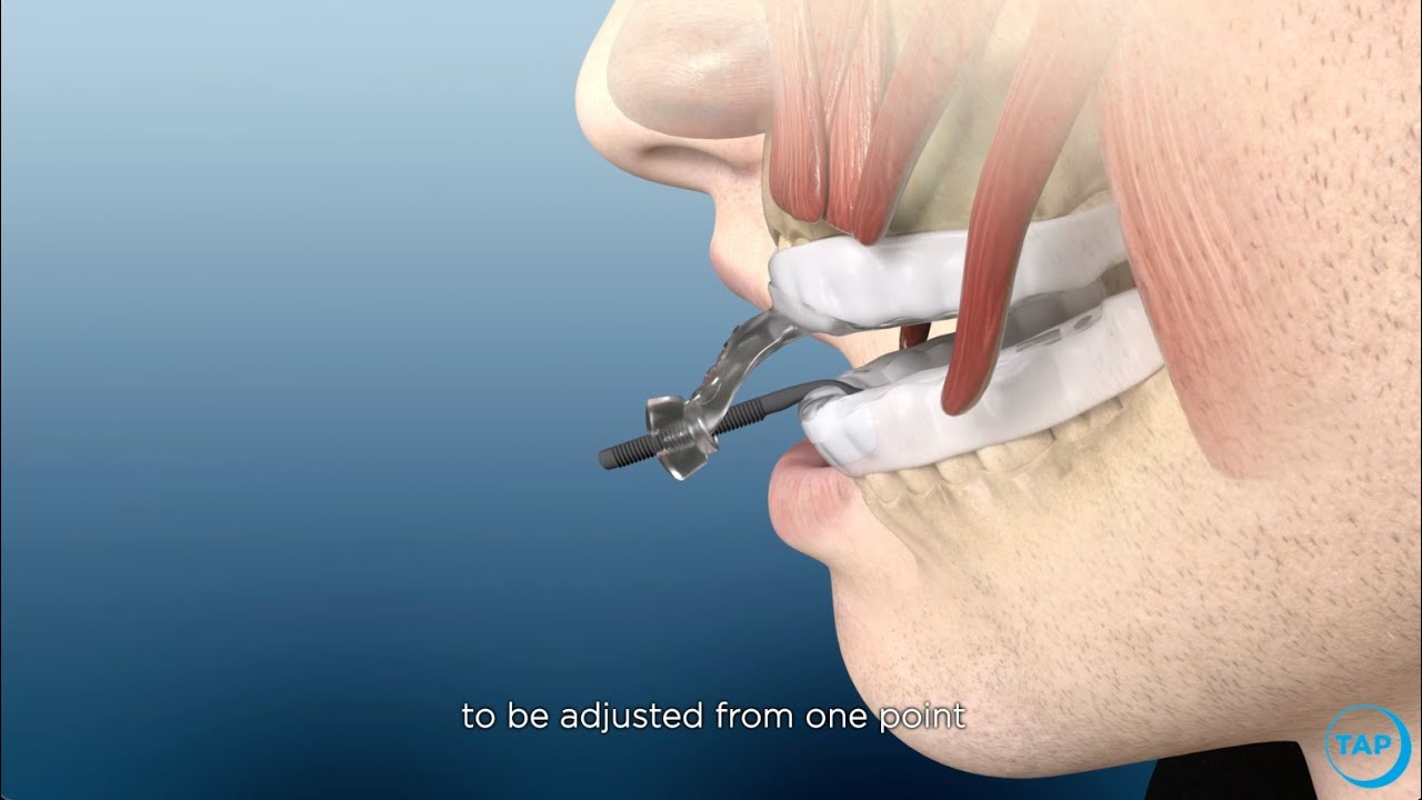 myTAP Oral Appliance for Snoring & Sleep Apnea: How Does It Work?