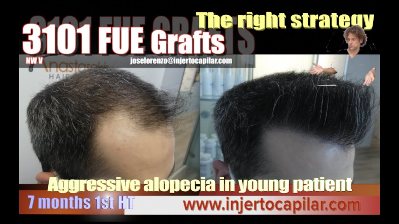3101FUE Grafts.Aggressive alopecia in young patient. 7 months 1st HT. Injertocapilar.com.10/2022