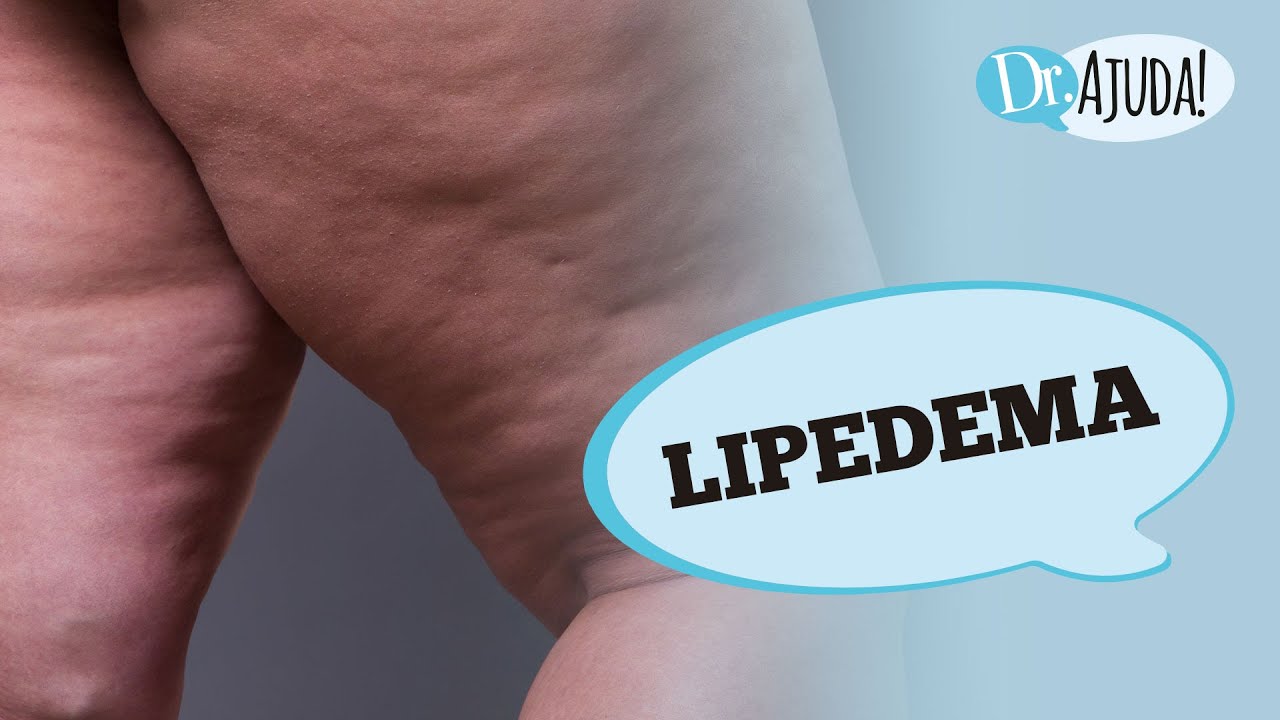 LIPEDEMA: O QUE É, SINTOMAS, DIAGNÓSTICO E TRATAMENTO