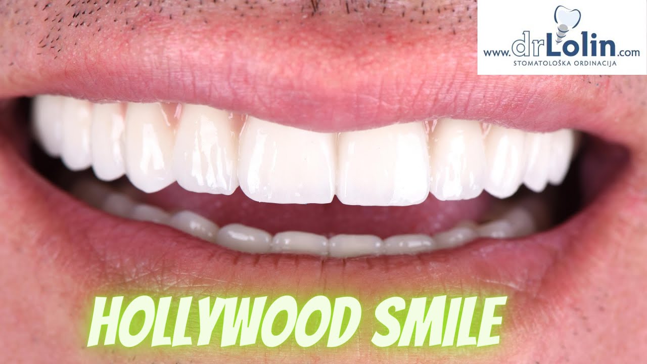 Hollywood smile Boja A1