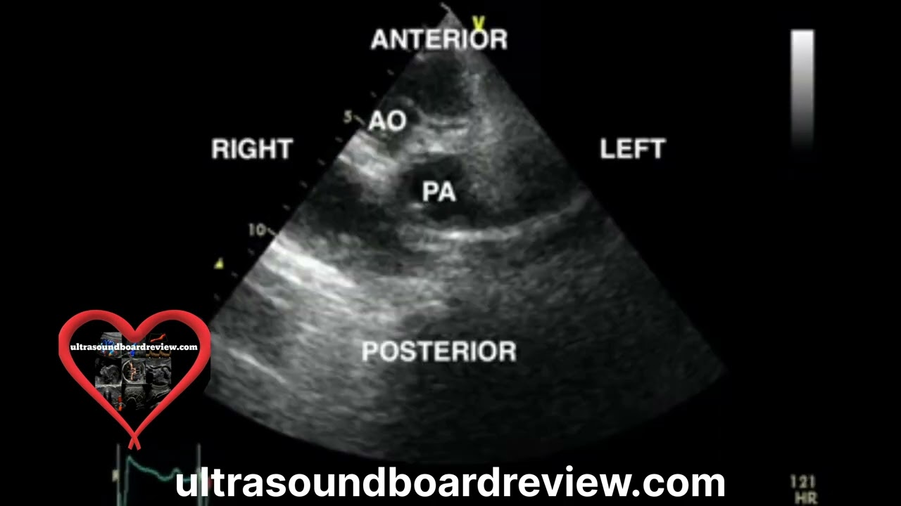 Transposition of the Great Arteries Echocardiogram