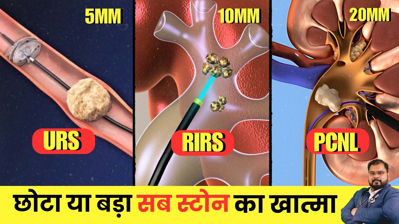 Kidney Stone 5mm - 20mm : कब दवा से निकलेगा और कब सर्जरी चाहिए?