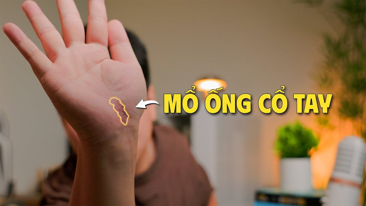 Review sau khi mổ HỘI CHỨNG ỐNG CỔ TAY | Có đau không, chăm vết thương thế nào,...