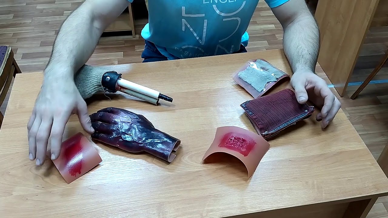 Обморожение