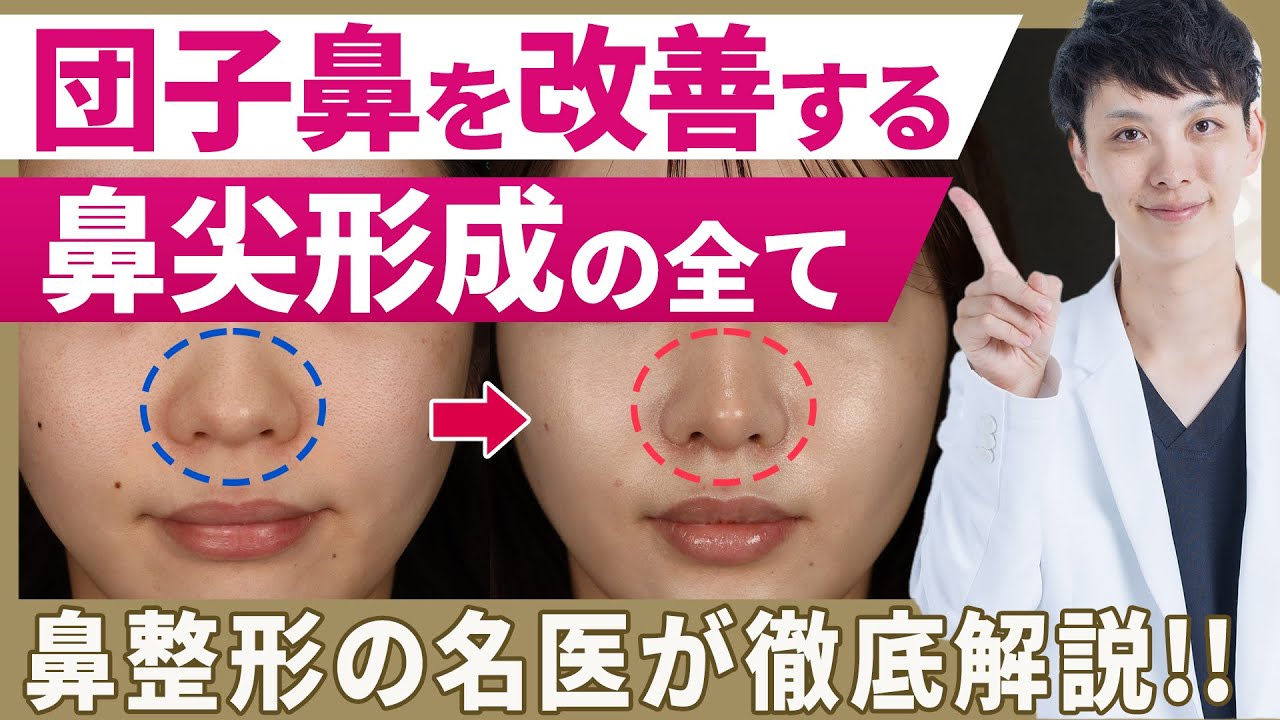 【鼻尖形成】団子鼻を自然に細く仕上げるコツを医師が徹底解説【症例解説】【美容整形】