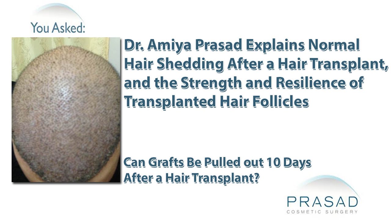 Why Hair Grafts are so Strong they Can't Fall Out, & Normal Hair Shedding after a Hair Transplant