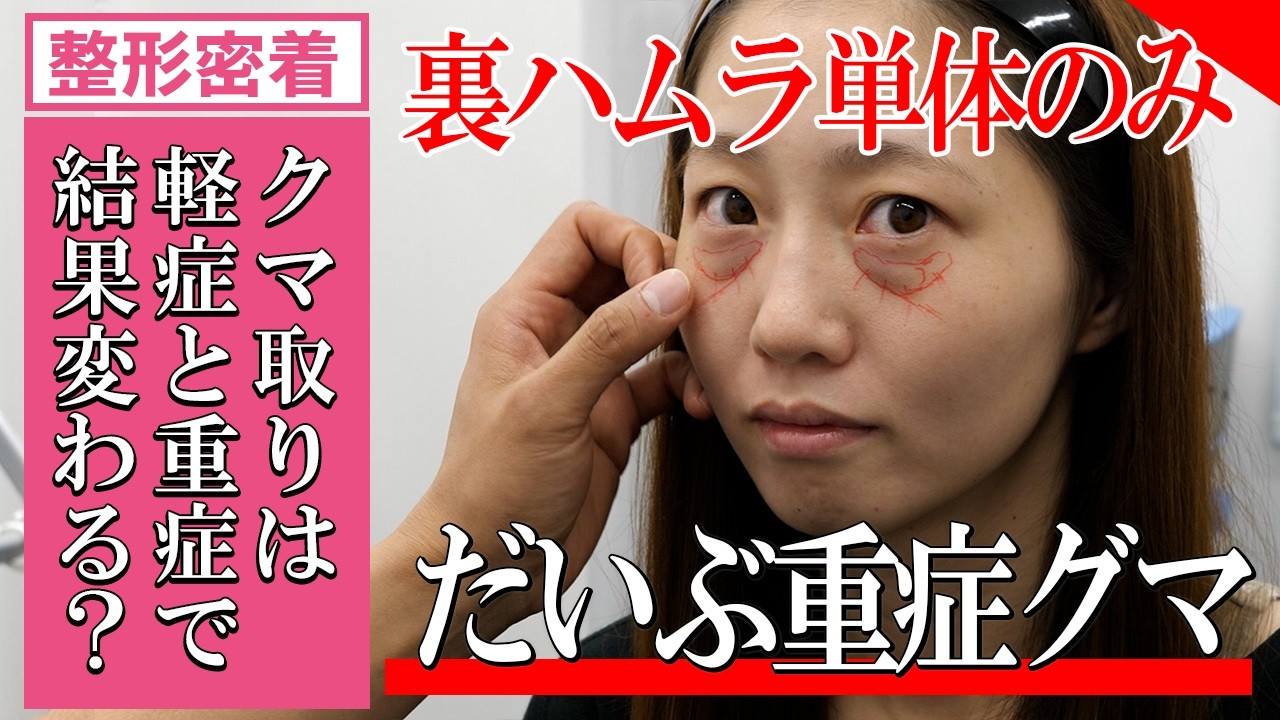【クマ取り裏ハムラ比較】重症と軽症でクマの治り方は変わるのか？ダウンタイムと仕上がりを比較した結果【整形密着】湘南美容クリニック