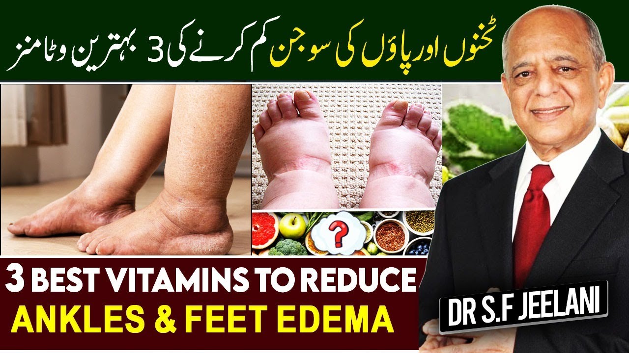 3 Best Vitamins to Reduce Ankles & Feet Edema | ٹخنوں اور پائوں کی سوجن کم کرنے کی 3 بہترین وٹامنز