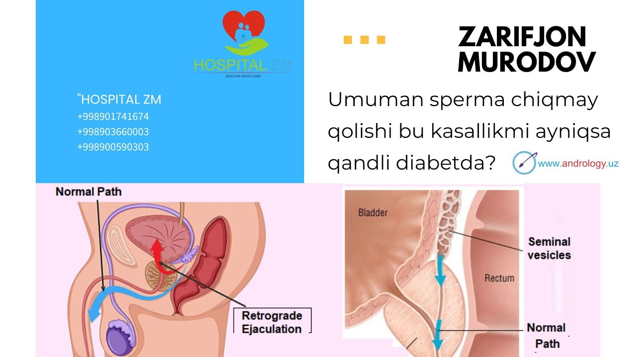 Sperma umuman kelmay qo'ydi Retrograd eyakulyatsiya