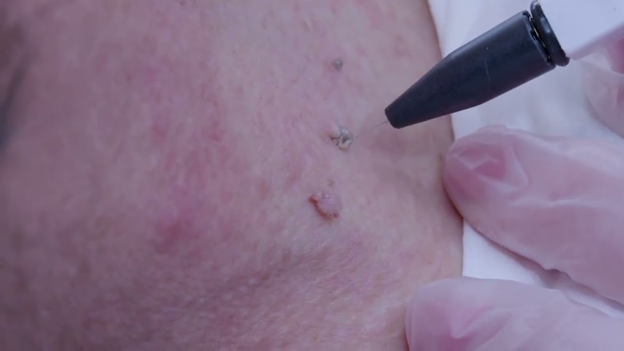 Skin Tag Removal Treatment | Eden Skin Clinic Treatments