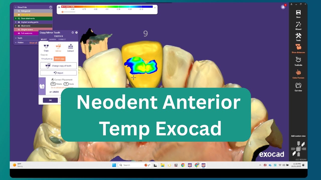 Neodent Anterior Temp Exocad