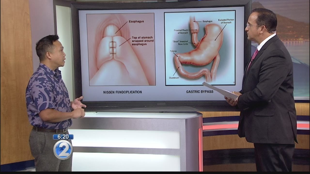 Ask a Specialist: Gastroesophageal Reflux Disease and Obesity Healthy