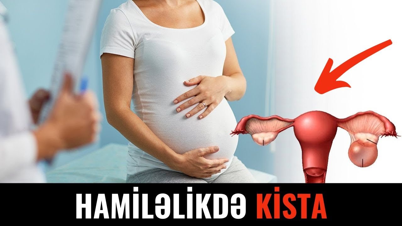 Hamiləlikdə Kista Yarandıqda Müalicə İlə Sorula Bilərmi?