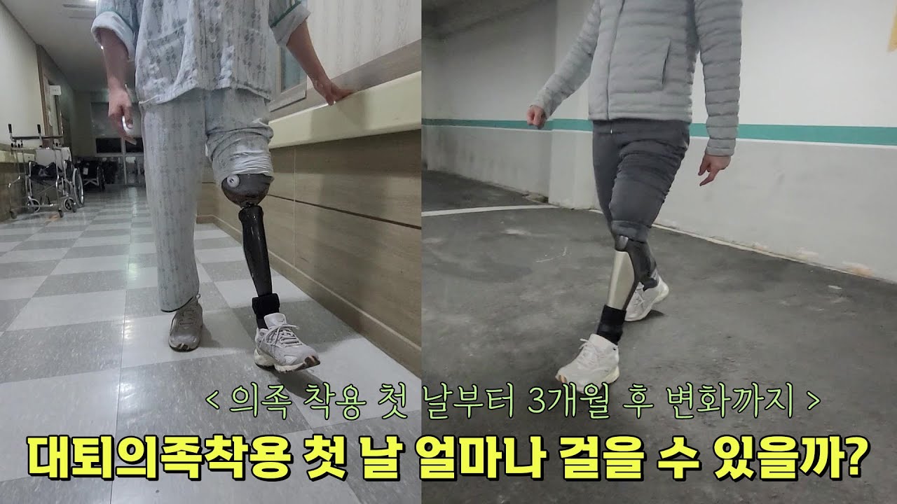 대퇴의족 착용 첫 날 얼마나 걸을 수 있을까? 씨렉4 착용 첫날~3개월후